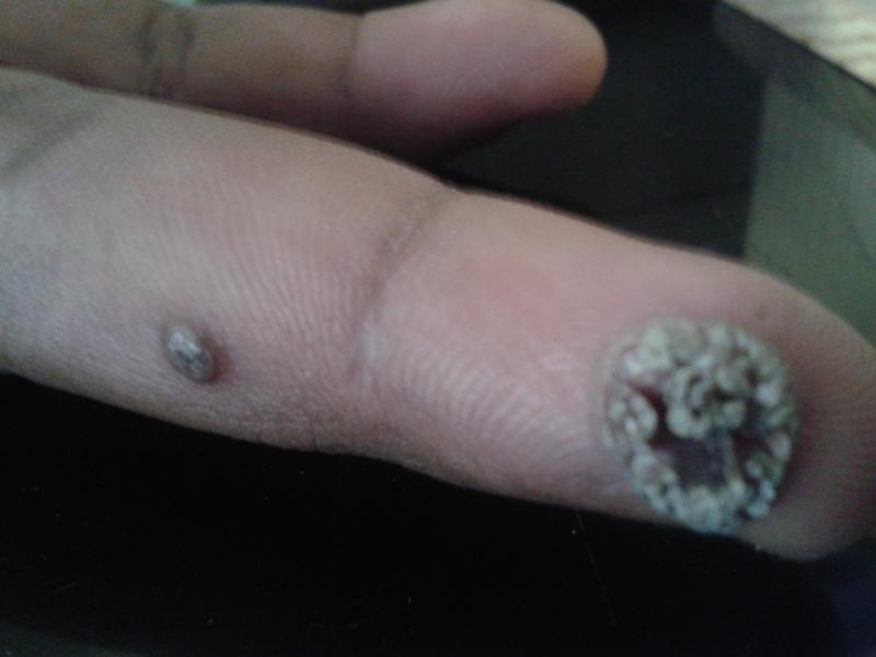 Chronic case of warts-recurrent on fingers,post cauterisation it came back again